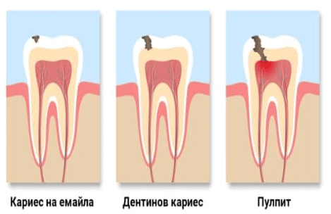 Лечение на пулпит Гоце Делчев | Family Dental Care